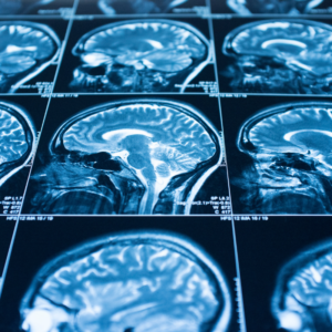 covid brain damage study
