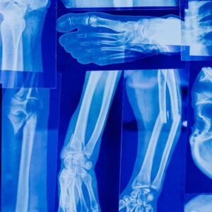 osteoporosis